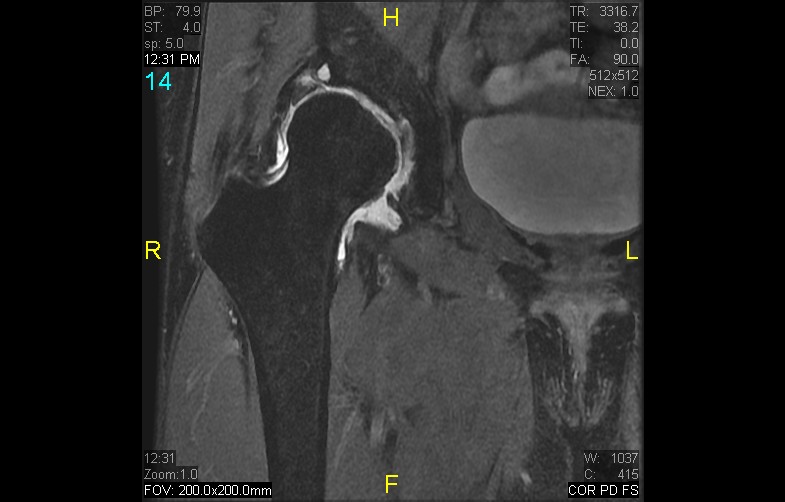 Figure 3 for case History Perthes Disease